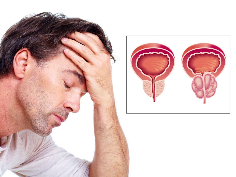 prosztata adenoma impotenciával